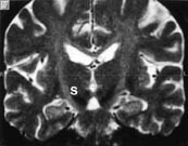  Figur 2    Frontalt snit, som demonstrerer målorganet, i dette tilfælde nucleus subthalamicus (S)