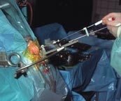  Figur 3    Den operative opstilling ved implantation af elektroder i nucleus subthalamicus. Stereotaksirammen er skruet på…