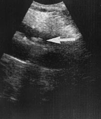  Figur 4    Konkrementer distalt i moderat dilatert ductus choledochus (9 mm)