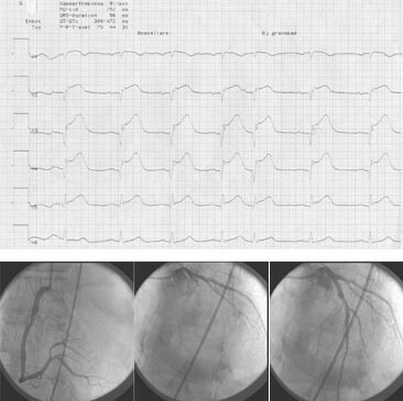 Figur 1  a) 77 år gammel mann med EKG-forandringer forenlig med et fremreveggsinfarkt.  b) Koronarangiografi av høyre…