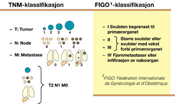 Figur 1  Stadieinndeling etter TNM-klassifiksjonssystemet der sykdomsutbredelsen angis på grunnlag av størrelsen på svulsten…