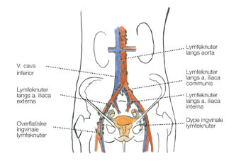 Figur 2  De primære lymfeknutestasjoner ved gynekologiske kreftformer: langs kar i lyskene, i bekkenet og langs aorta