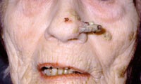 Figur 11  Cornu cutaneum (hudhorn)