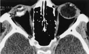 Figur 3  Aksialt CT-bilde viser best forkalkningene (piler) ved bilateralt retinoblastom