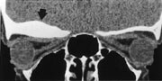 Figur 2  Spiral-CT-bilde rekonstruert fra 3D-opptak viser osteom med beinfortykkelse i orbitataket høyre side (pil)