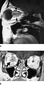 Figur 6  a) 54 år gammel kvinne med høyresidig optikusmeningeom. Nerven har lavere intensitet enn tumor i det parasagittale…