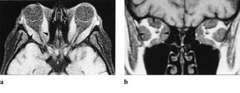 Figur 7  a) 48 gammel kvinne med exophthalmus og synsaffeksjon. Koronalt T1-vektet MR-bilde viser at synsnerven er…