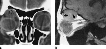 Figur 9  a) 17 år gammel pike med kapillært hemangiom. Koronal CT viser beinusur (pil). b) Sagittalt T1-vektet MR-bilde…