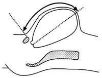 Figur 1 Symfyse-fundus-målet måles fra øvre kant av symfysen til toppen av livmoren. Målebåndet skal ligge langs huden til…