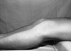 Figur 4  Gravity sign-test med bagudsynkning af tibia resulterende i ”hængekøjefænomen”