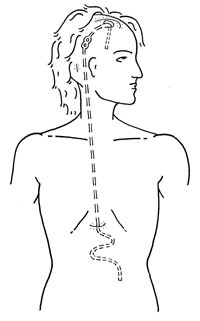 Figur 1   Skjematisk tegning av en ventrikuloperitoneal shunt innlagt ved hjelp av to hudsnitt på hode og ett i epigastriet…
