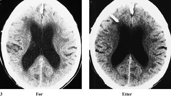 Figur 3   Postoperativ bedring ved testing kan ofte sees på tross av at ventrikkelstørrelsen er tilnærmet uendret. CT-bilder…