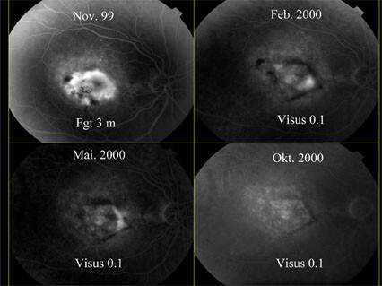 Figur 2  Fluoresceinangiografi av netthinnen hos en pasient. Bildet i november 1999 er tatt før behandling (Fgt =…