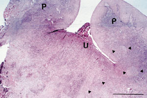 Figur 2 Pasient 2. Biopsi av slimhinnefolder i vestibulum på høyre side i underkjeven hos 22 år gammel mann med Crohns…