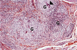 Figur 3 Pasient 2. Granulomer (G) med epiteloide celler, kjempecelle av fremmedlegemetypen (pilhode) og lymfocytter…
