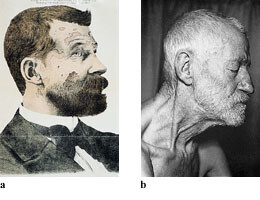 Figur 1   a) Pasient med sarkoidose, beskrevet av Boeck 1899 (6).  b) Samme pasient 80 år gammel