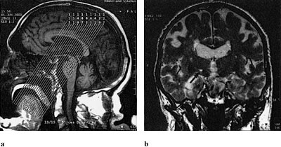 Figur 1   a) Cerebral MR med illustrasjon av projeksjon og  b) høysignalgivende lesjon i nucleus subthalamicus på høyre side…