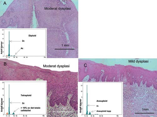 Figur 2 DNA-ploiditetsdistribusjonshistogrammer (innfelt) og histologiske funn hos to pasienter med moderat dysplasi (A og…