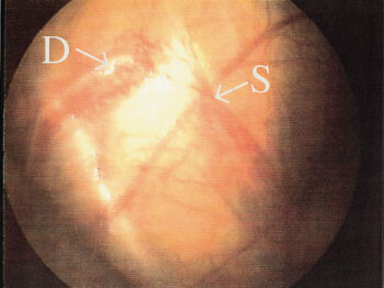 Figur 2   Laparoskopisk bilde av høyre side viser at ductus deferens ender blindt (D), og at v. og a. spermatica ender…