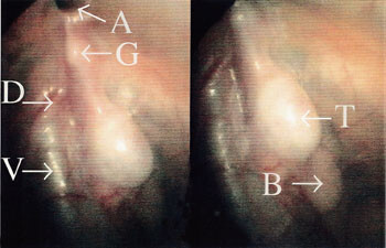 Figur 3   Laparoskopisk bilde av høyre side. A er åpenstående processus vaginalis, G er gubernaculum testis, D er ductus…