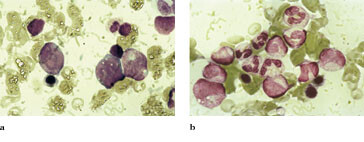 Figur 2 Pasientens beinmargsutstryk a) før og b) etter tre måneders kortisolbehandling. Før behandling er margen noe…