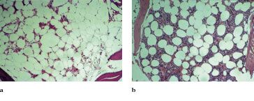 Figur 3 a) Beinmargsbiopsi før substitusjonsbehandling med kortisol. Beinmargen er hypocellulær med en cellularitet på 15 …