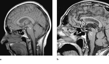 Figur 4 a) En normal sella turcica med en normal hypofyse (a) og hypofysestilk (b). b) Primært tom sella-syndrom…
