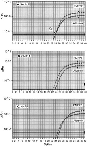 Figur 2   Sanntid (real-time) kvantitativ PCR-amplifikasjonsplot av genet PMP22 mot albumin som referansegen. A) normal…