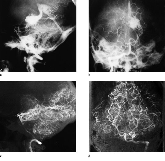 Figur 2   Total obliterasjon av en 4 cm³ stor arteriovenøs malformasjon ved lamina quadrigeminalis. a, b) Øverst: Side- og…