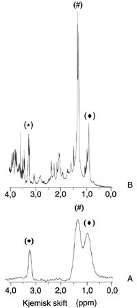 Figur  1 A) In vivo-MR-spekter, invasivt brystkarsinom, 1,5 tesla. Spekteret ble tatt opp fra et volum på 2 ¥ 2 ¥ 2 cm³, med…