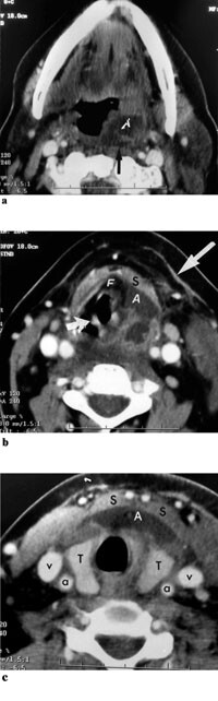 Figur  3  Kontrastforsterket CT hals gjort dag 1. a) Snitt i tonsillnivå viser abscedering submukøst på venstre side, og med…