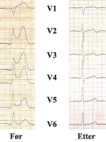 Primær angioplastikk blir anbefalt som standardbehandling ved akutt hjerteinfarkt med ST-hevning på EKG. Figuren viser…