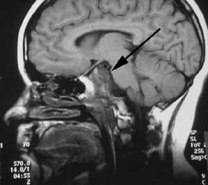 Figur 2 a) Preoperativ sagittal MR-undersøkelse med kontrast av kordom i clivus (pil)