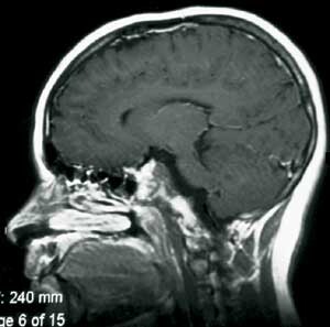 Figur 2 b) Postoperativ sagittal MR-undersøkelse med kontrast av kordom i clivus