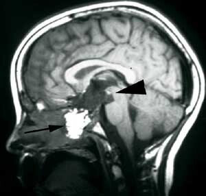 Figur 3 b) Postoperativ sagittal MR-undersøkelse med kontrast av kraniofaryngeom. Svulsten er borte (pilhode) og det er lagt…