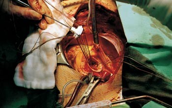 Innsetting av aortaventil er blitt et hjertekirurgisk rutineinngrep. Bildet fra en hjerteoperasjon ved St. Elisabeth…