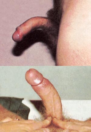 «Ved fotografering i erigert tilstand kan anomalien best bli demonstrert for legen,» slo forfatterne fast da impotens var…
