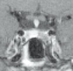 Figur 1 Mikroadenom i hypofysen. Koronart T1-vektet MR-snitt med kontrast. Nederst sentralt ses luft i sinus sphenoidale …