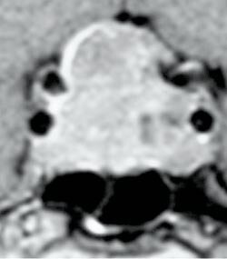 Figur 2 Tumor med lateral og suprasellær utbredelse. Svulsten har invadert sinus cavernosus og vokser delvis rundt…