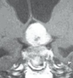 Figur 3 Stort hypofyseadenom hos mann, 52 år med økende hukommelsestap, ustøhet og dårlig syn. Tumor vokser inn i 3…