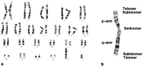 Figur 1  a) Karyogram av en normal mann. Bildet viser alle kromosomene etter at de er behandlet med fargestoffet giemsa (G…