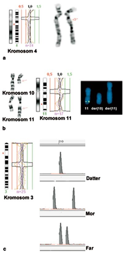 Figur 5  CGH-analyse av barn med mental retardasjon og dysmorfe trekk. a) En delesjon på den lange armen av kromosom 4 er…