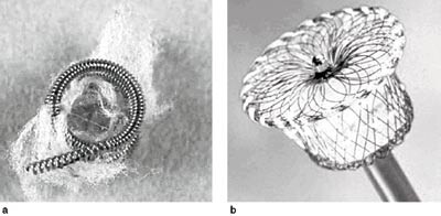 Figur 1  a) Ein oppkveila ståltråd dannar ein spiral, her med diameter 5 mm. Polyestertrådar induserer trombose, som gir…