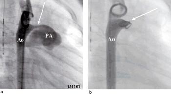 Figur 2  a) Angiokardiogram med injeksjon av kontrastmiddelet i aorta (Ao). Arteria pulmonalis (PA) vert fylt gjennom den…