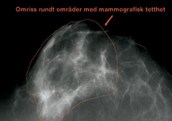 Figur 1b  Operatøren tegner et rødt omriss som inneholder lyse områder med mammografisk tetthet. Dette omrisset inneholder…