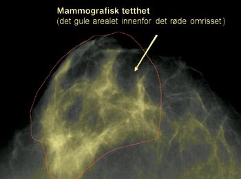 Figur 1c  Operatøren fargelegger gult de lyse områdene som representerer mammografisk tetthet. Programmet regner ut…