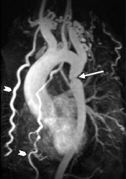 Figur 1  Kontrastforsterket MR-angiografi av coarctatio aortae (lang pil). Dilatasjon av begge aa. mammariae int. (brede…