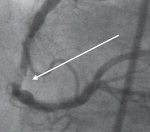 Figur 2  Høyre koronararterie med trombe i midtre del (pil). Bildet er utlånt av Hjerte/kar radiologisk avdeling, Ullevål…