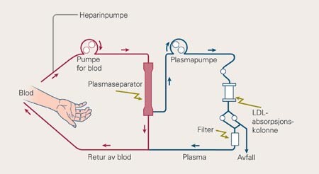 LDL  -aferese med forutgående plasmaseparasjon fra KANEKA. Pasientens plasma utskilles ved hjelp av plasmaseparator og…