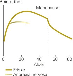 Osteoporose er vanlig hos pasienter med langvarig anorexia nervosa. Flere studier viser økt risiko for brudd som følge av…